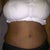 Swelling here, but because of the breast reduction.