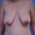 Pre-op photo by my nurse.