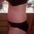 13 days post op from original surgery and 9 days post op from emergency surgery