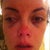 Right after I got home - about an hour after surgery.  The bruising is a'comin' (No, that's not a crying face...that's the results of a drippy nose!  Don't forget the tissues!).