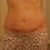 Revision incision is a little swollen but I love that the vertical is gone!