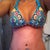 3 days after. swollen and looking forward to seeing what the vertical looks like under the tape.  love that I have something to fill up the top of my swim suit though.  280cc high profile silicone