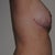 5 weeks post-op