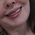 after permanent lip augmentation