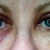 Day 3 Open. Under right eye very swollen and bruised. Bruising starting to appear under left eye.