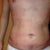 Day 3 post-op torso