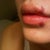 about 36 hrs after juvederm ultra plus