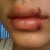 10/30/11. Almost 48 hrs after juvederm ultra plus