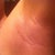 Incision 6 weeks
