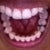 Lower jaw after Invisalign.  My lower jaw wasn't as bad, but I did have a cross-bite which no longer exists.