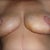 They are a little discolored and little swollen. But healing very nice. No openings, No infection,