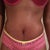 PO Day 15 This pic shows the swelling around my flanks. My pubis area is swollen too! :/ I think that there is fluid there too :