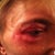 After Photo. No change to Before and After photos. Dents and scar-trough depressions never filled.