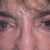 Dr. Levine’s Before Office Photo. Before surgery, pupil size the same.