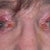 Dr. Levine’s After Office Photo. Following surgery, another eye specialist noted my left pupil was enlarged and didn’t dilate. This indicates a potentially serious and irreversible complication.