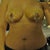 Day 6 - Post Op
A better picture to show the scale of the new size to my body.  Bruised every colour of the rainbow.