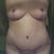 My doctor is fabulous!!! What a HUGE difference with that roll/flap of skin/fat gone!!!!