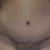 Close up or scar & bellybutton, new stretch marks....and a dogear on my right. Doc said he'd fix it at 6 months if it's still there.