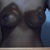 12 days out right breast has more puckering than the left.