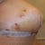 Post op day 9