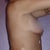 Right Side View 2.08.13 (36 hours after surgery)