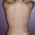 Back View 2.08.13 (36 hours after surgery)