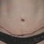 7 days scars. still so bloody looking because the incision is covered by glue and i cannot wash off the scabs and blood crusts