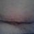 The Redness at the incision when will that go down and the "Puckering" look I see.