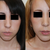 One year post-op -- frontal view