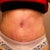 6 weeks post op