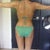 Backside 5 months after surgery