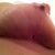 Day 14 right breast where hematoma was, now  small opening.
