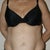 Pre-Tummy Tuck