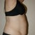 Pre-Tummy Tuck