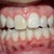 Before treatment
