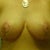 post op day 31. Bit blurry, sorry about that.