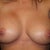 10/22/2011 - 3 Days Post Revision - You can still see that they are not symmetrical and the right side is sitting rather high.  In contrast, this makes the left one look saggy.  Again, the doctor says that it may look the same as it did prior to revision until it has time to heal and settle.