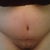 I guess this is what people are calling "swell hell"! very very swollen!
Post Op Day 11 Just had my last drain removed and close up of my scar