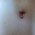 POD 10: my triangular BB. I hope it heals ok right now it looks strange and there are sutures at the top so I hope I don't get the traditional suture scarring. The faint dot above is where the stem is so I thing the idea is that it will retract and become circular.
