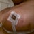 7 days Post Op, bruising! Hoping the Arnica is helping
