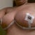 7 days post op