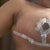 7 days post op, ton of swelling on the sides where drains were ;( looks like side boobage