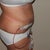 3 Day Post Op, Side