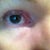 Slight 'pulling' inside corner of eye was noticed after swelling receded at 5 weeks