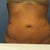 My stitches have not been removed yet so my "scars" look really big and ugly. I'm hoping they will look better once they the stitches are removed Friday.