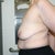 Dec. 06, 2010 Left arm Lipoma