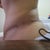 9.5 weeks post op