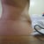 9.5 weeks post op