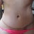 4 months post op