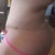 4 months post op